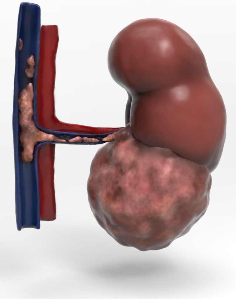 Representative schematic of a kidney cancer with associated venous tumour thrombus. Illustration by Claire Cooper.