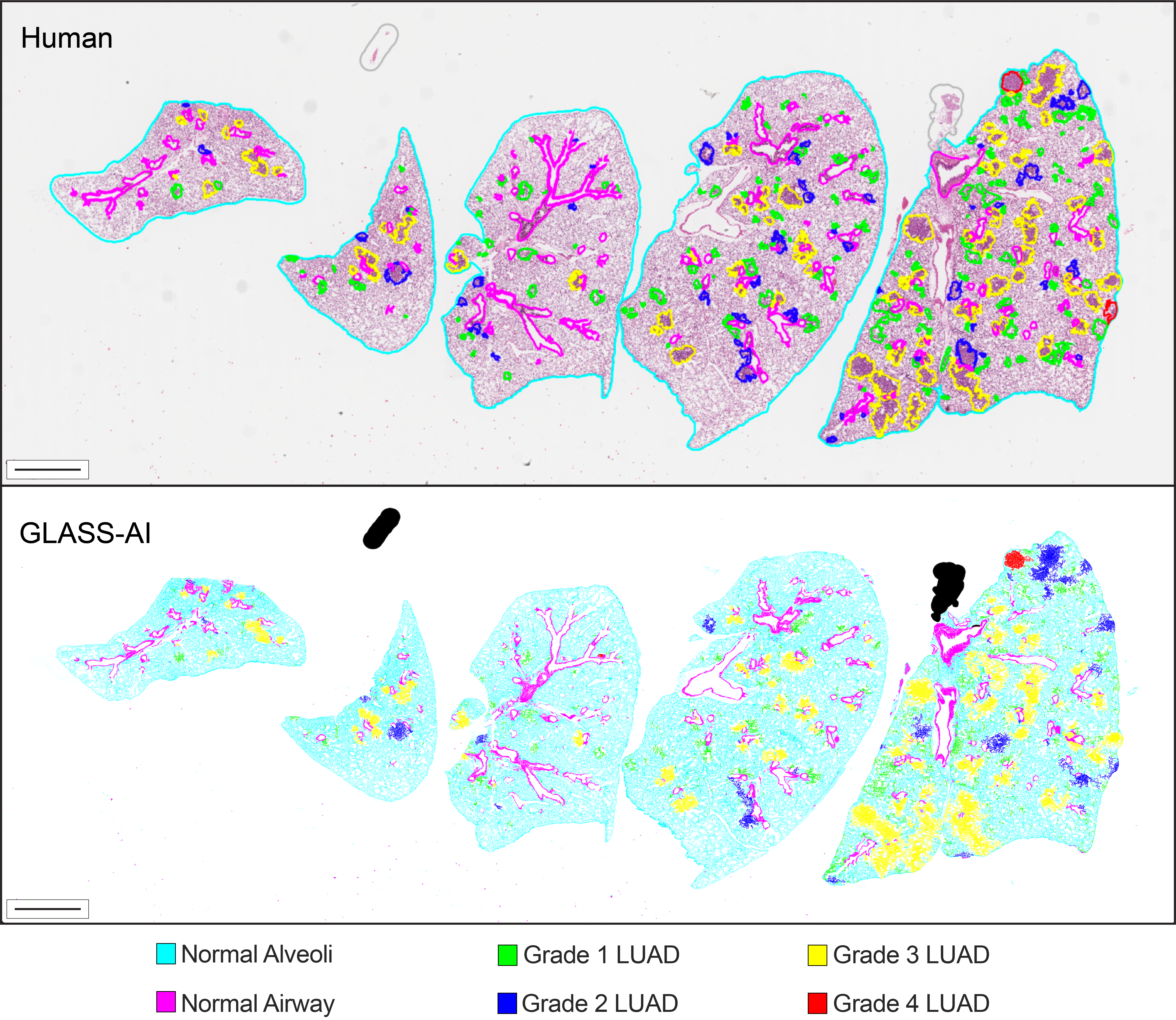 On top: A hematoxylin and eosin-stained cross-section of mouse lungs showing manual annotations of the tumors throughout the lungs. On bottom: A map of tumor grades and normal tissue types in the same cross-section generated by GLASS-AI.