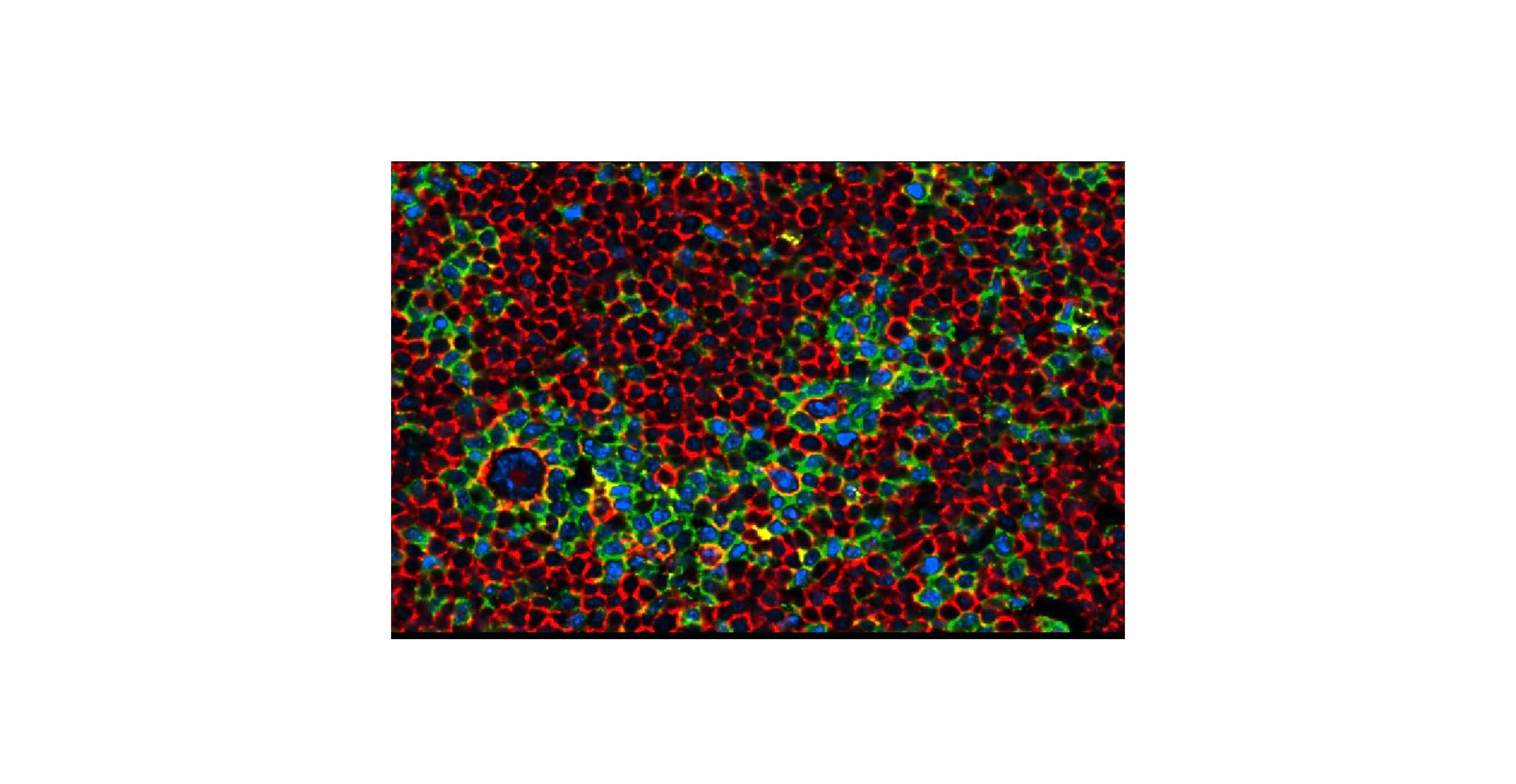 A single lymphocyte predominant tumor B-cell in NLPHL surrounded by a rich inflammatory microenvironment of a variety of cell types is highlighted by CODEX imaging.