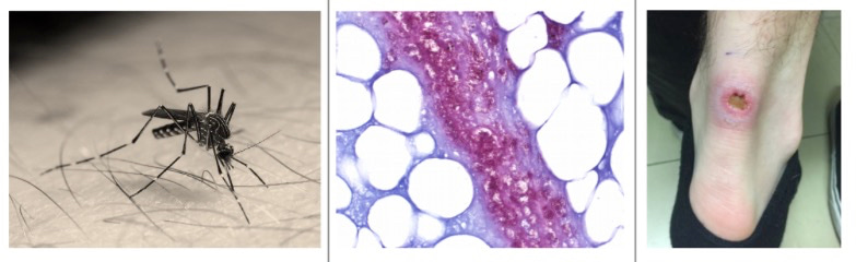Buruli ulcer transmission