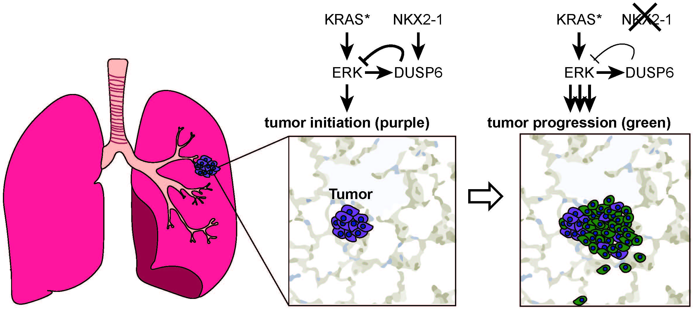 Loss of NKX2-1/DUSP6 signal promotes tumor progression