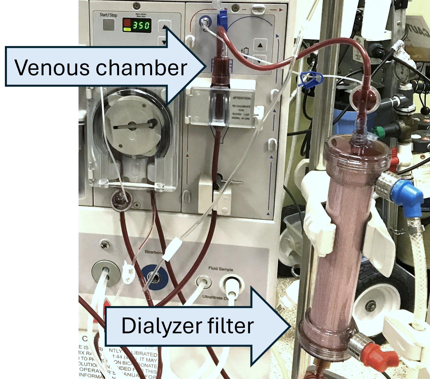 A visual scoring scale was used determine whether AB002 reduced clotting severity within the dialyzer circuit. This photograph of an intact dialyzer circuit shows the tubing, venous chamber and dialyzer filter that comprise the circuit.  At the end of each hemodialysis session, the circuit was inspected by a trained medical aide and assigned a numerical score to categorize the degree of clotting  within the venous chamber, shown here on the left and the filter, shown here on the right. After the circuit was scored, the filter was processed to quantify blood entrapment within the filter itself. 