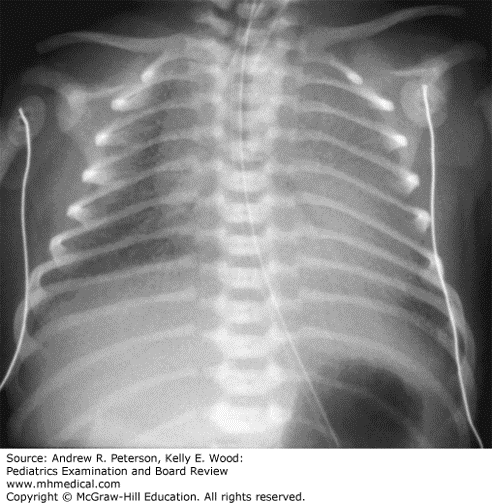 Respiratory distress syndrome. Bilateral ground glass opacities, poor inflation, and prominent air bronchograms are present on the chest X-ray of this infant with respiratory distress syndrome. (Reproduced with permission from Tintinalli JE, Stapczynski JS, Ma OJ, et al: Tintinalli’s Emergency Medicine: A Comprehensive Study Guide, 8th ed. McGraw-Hill Education, Inc., 2016. Fig 107-2.)