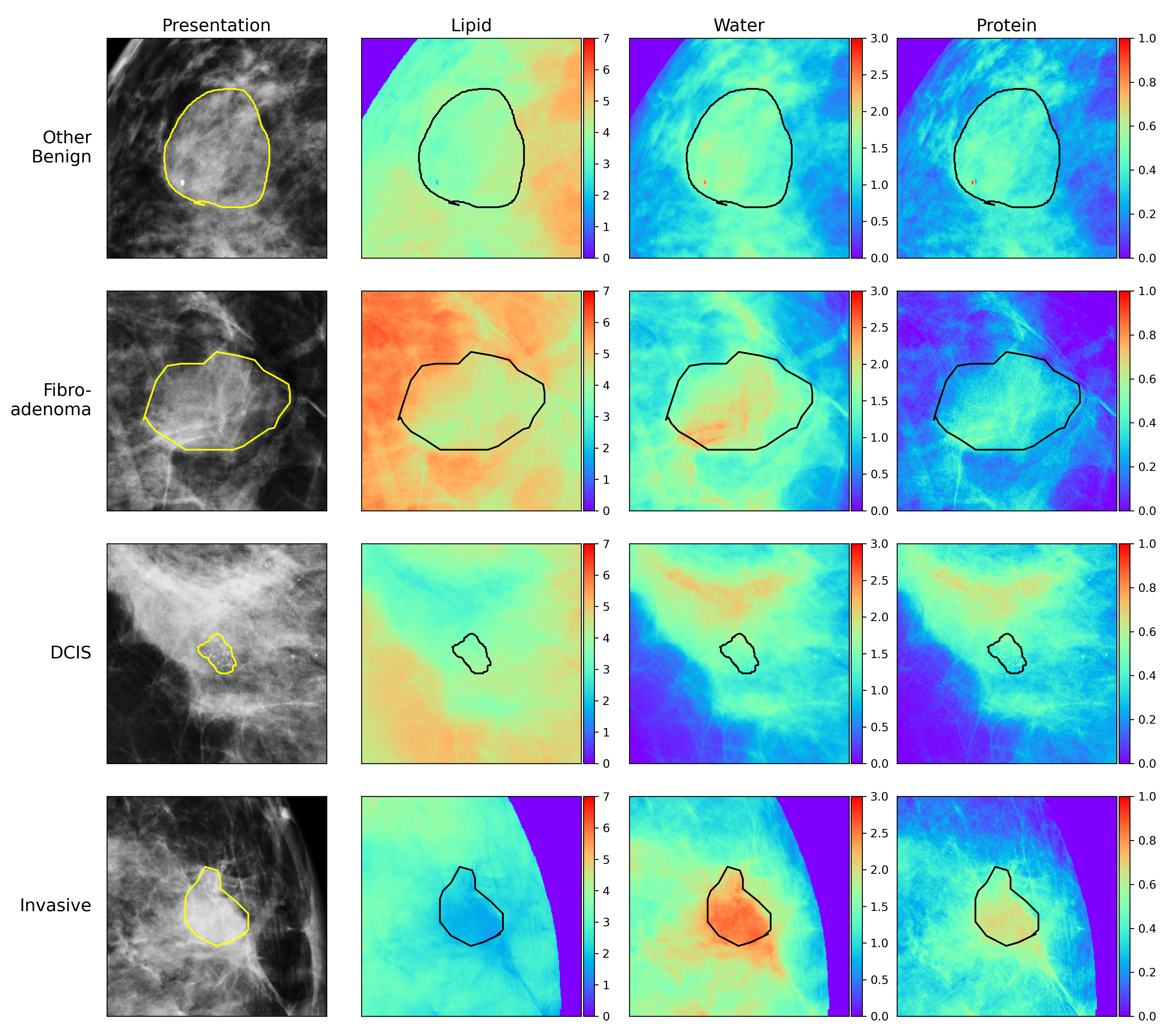 Standard mammography view and compositional imaging with radiologist delineations of breast leisions