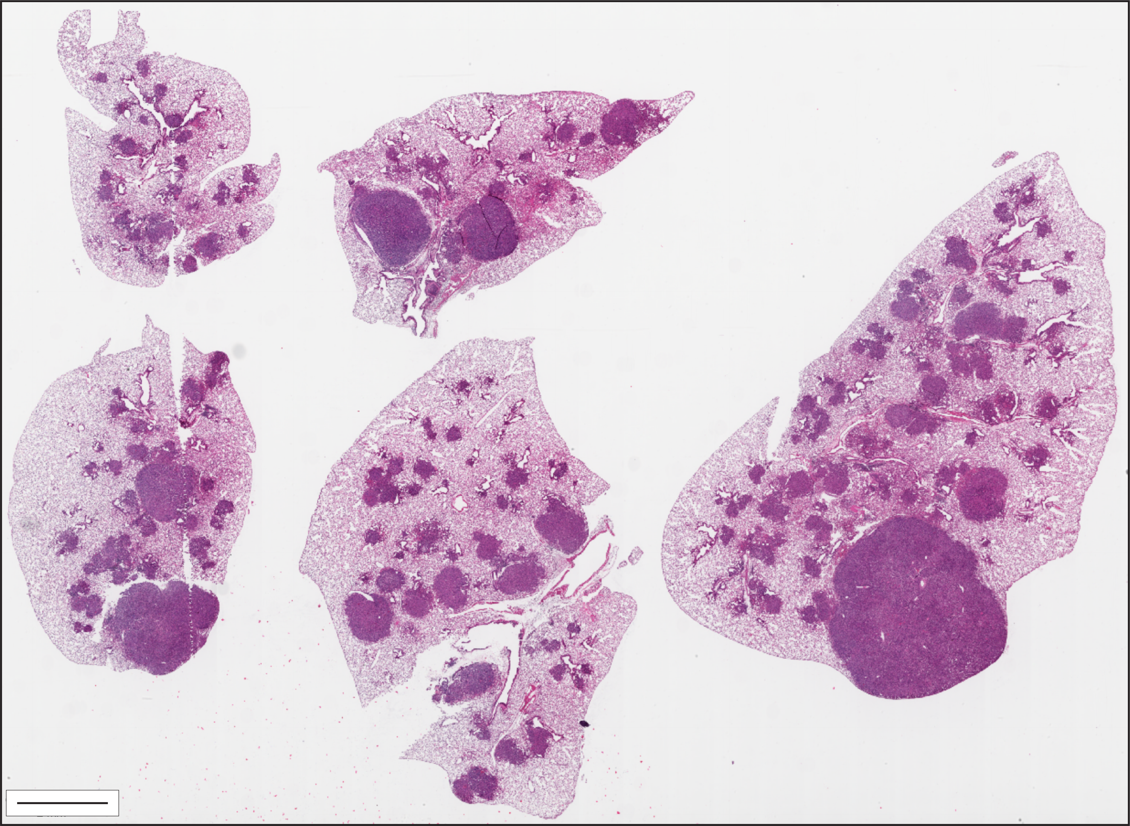 A hematoxylin and eosin-stained tissue cross-section of the five lobes of a mouses lungs showing many small tumors and several large tumors throughout the lobes