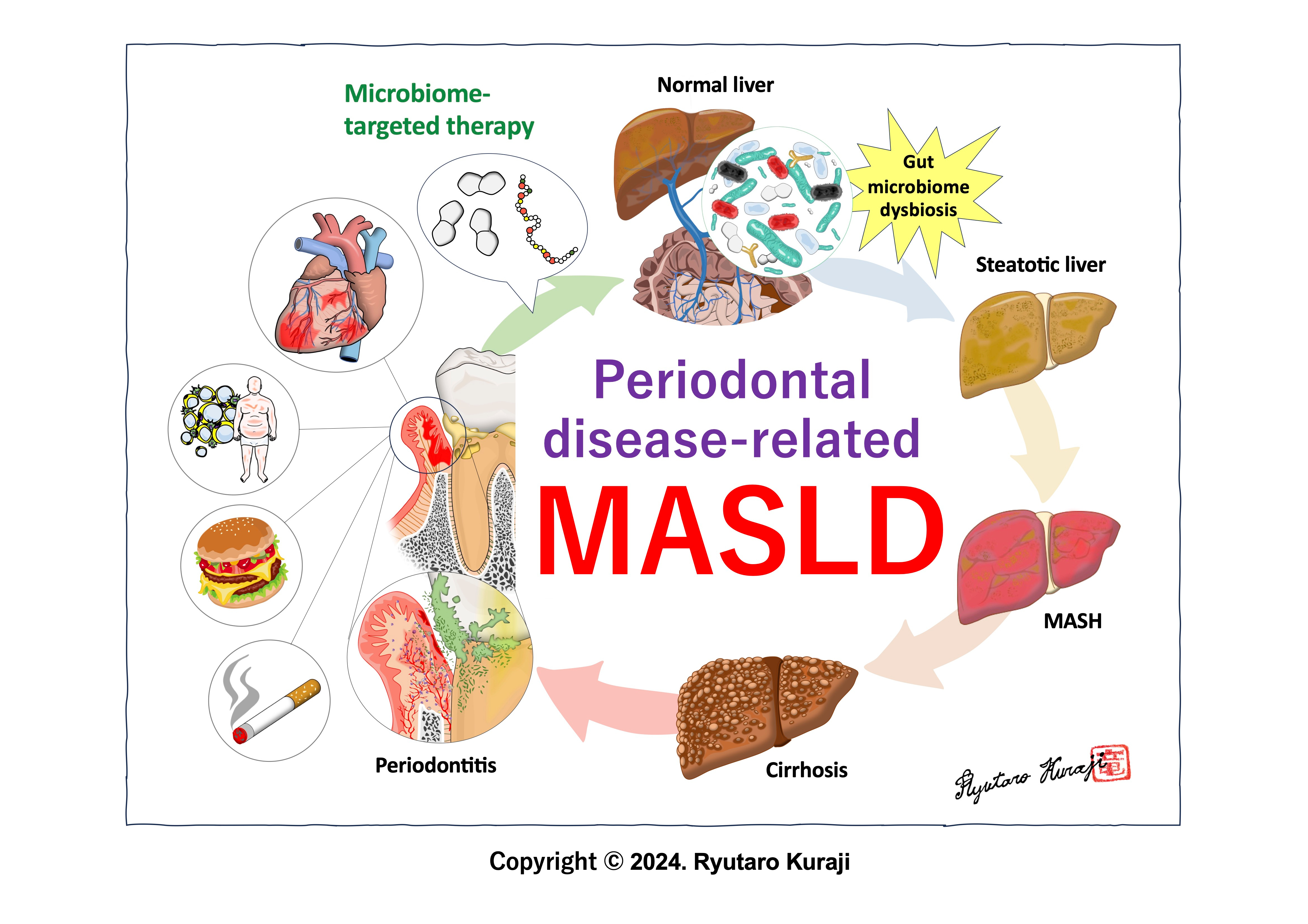 Emerging concept of periodontal disease-related-MASLD/MASH and microbiome-targeted therapy