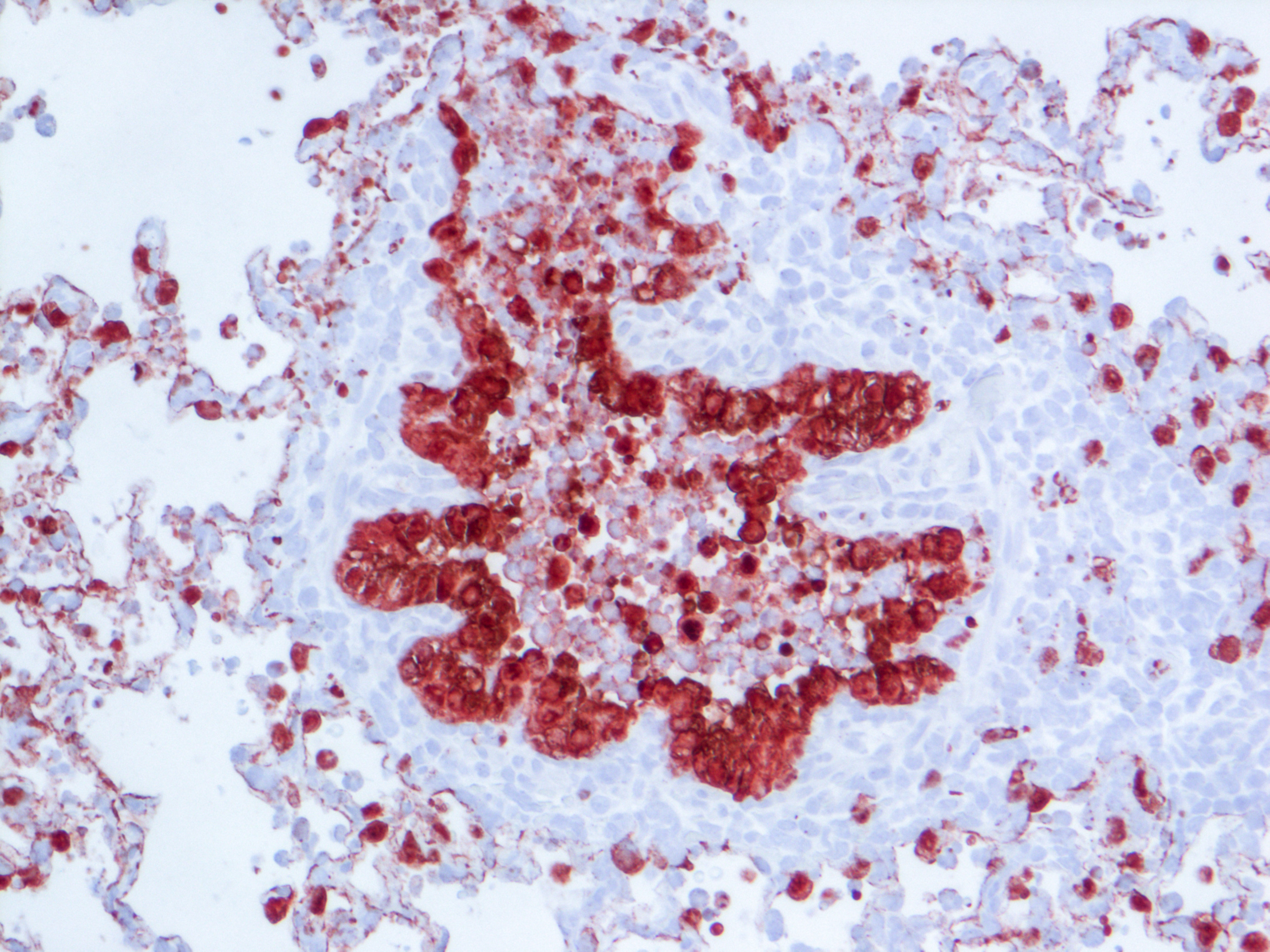 Bronchiole in 1918 flu infected lung
