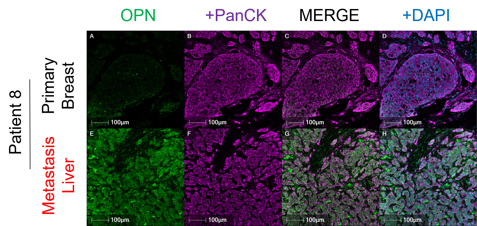Osteopontin expression patient-matched primary breast tumor versus recurrent metastatic tumor. Osteopontin expression patient-matched primary breast tumor versus recurrent metastatic tumor.