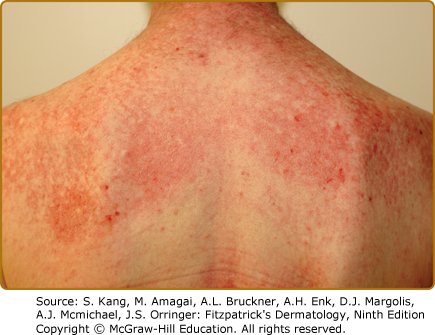 Fitzpatrick's Dermatology 9e Figure 62.5
