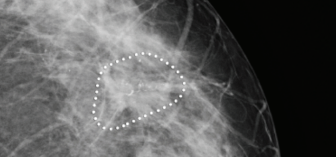 Illustration of suspicious microcalcification clusters using iCAD software on cranio-caudal views of a 74 years old woman with a lump in the right breast. iCAD software identified microcalcification clusters with suspicious morphology (iCAD Inc.