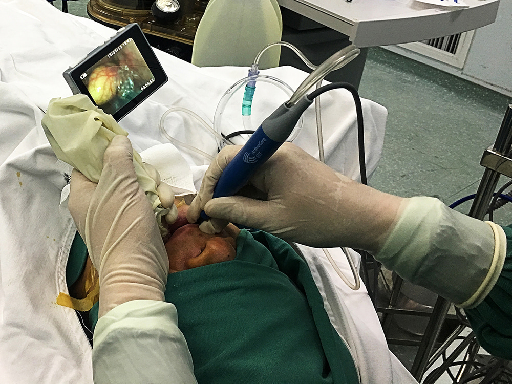 Intraoperative manipulation The surgeon was performing a videolaryngoscope-assisted coblation of epiglottic cysts.