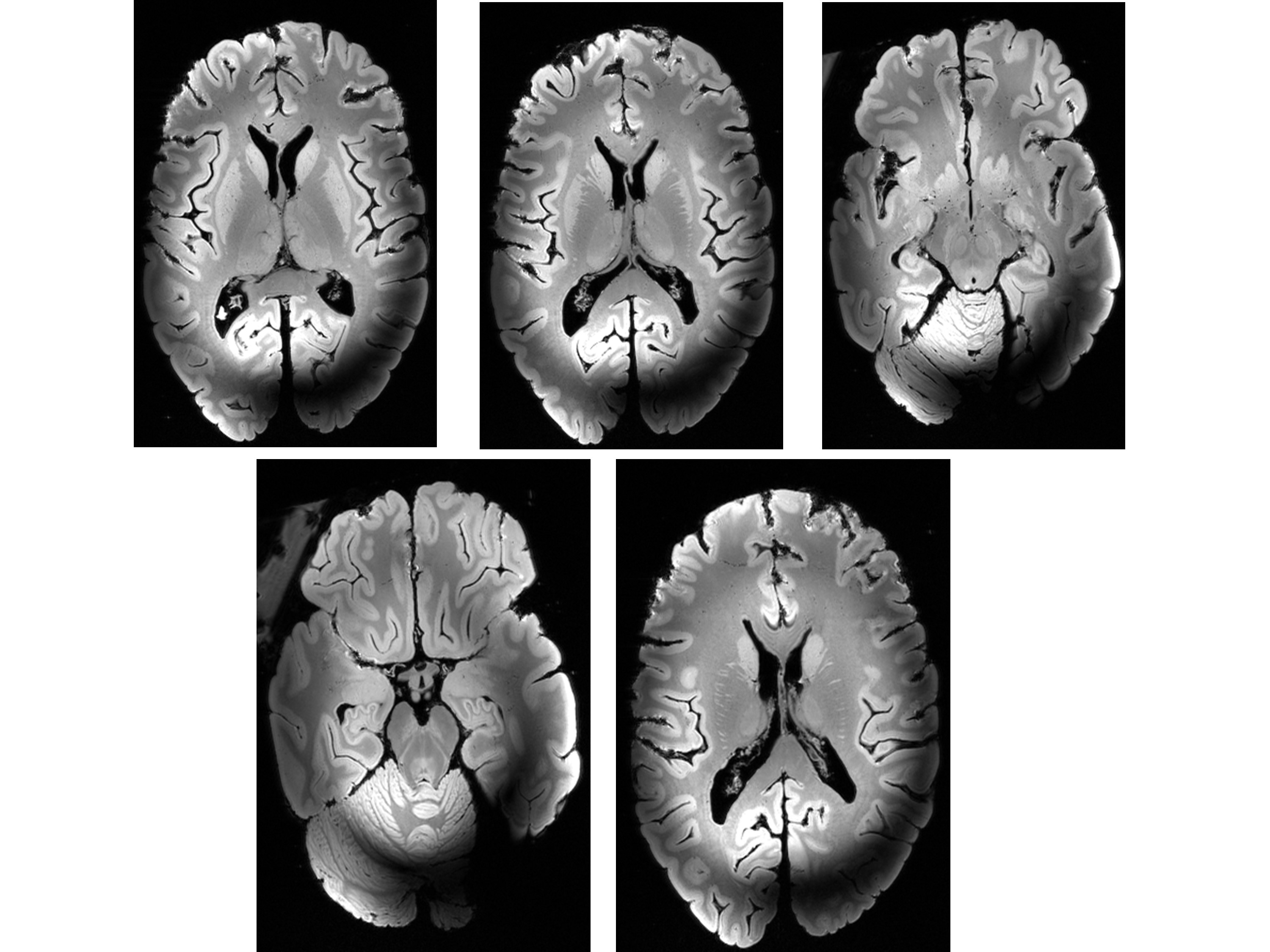 Figure 3: Ex vivo images of the human brain obtained with the Iseult 11.7T MRI scanner Images show exquisite details, but also artifacts resulting from the inhomogeneity of the 500MHz RF field due to its shortwave length compared to the brain size (brain sample courtesy of the Museum d’Histoire Naturelle, Paris).