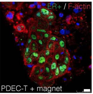 PDEC-tumor with ER expression after magnetic compression