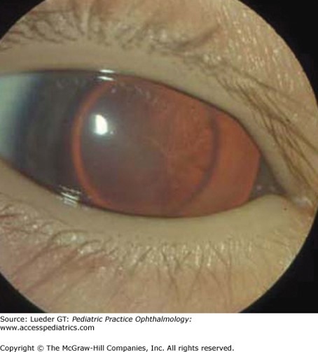 Eye Disorders Case 