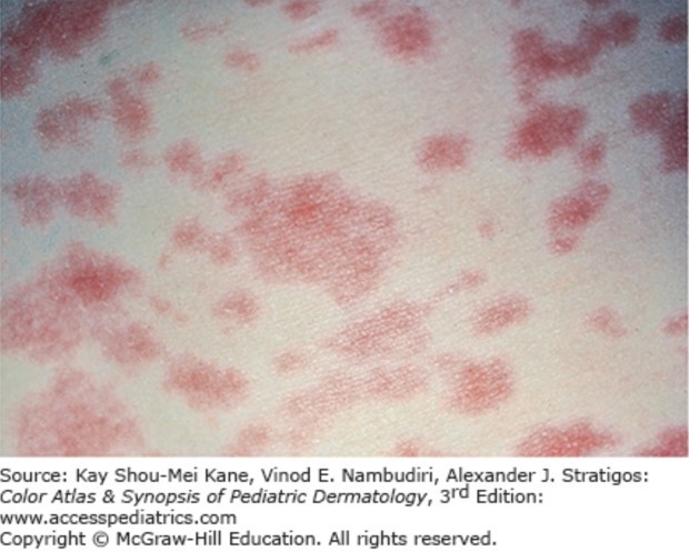 Measles Outbreak and Prevention 