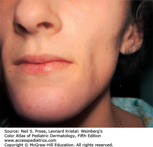 Panniculopathies Diagnosis