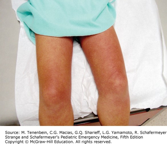 Scarlet Fever and Perianal Strep Diagnosis 