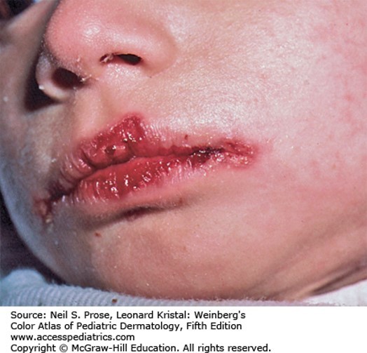 Cutaneous Manifestations of HIV Disease Diagnosis