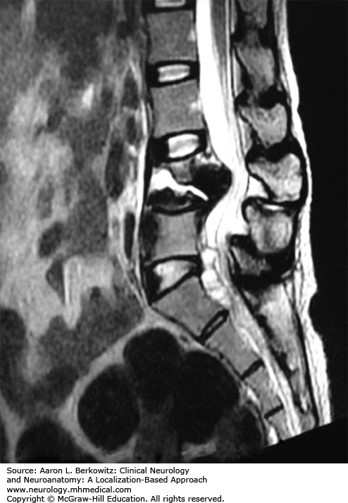 Infectious Diseases of the Nervous System Diagnosis