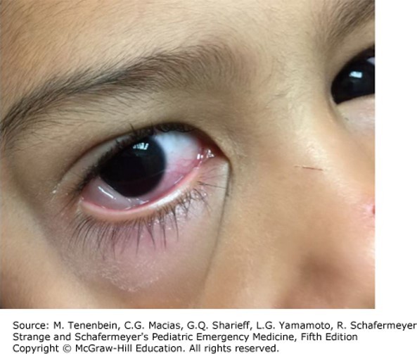 Eye Disorders Case 