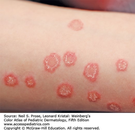 Superficial Fungal Infections Diagnosis