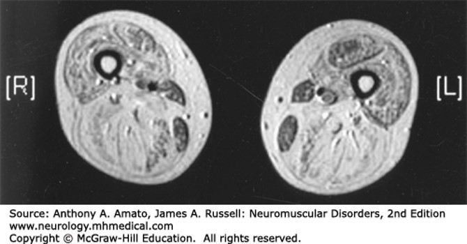 Muscular Dystrophies Diagnosis 