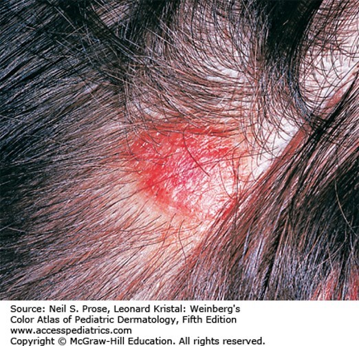 Infectious Disease Case 