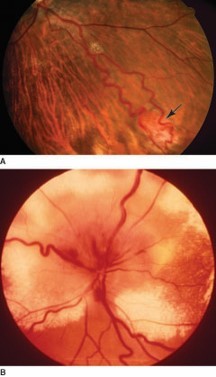 Neurovascular and Neurocutaneous Diseases Diagnosis