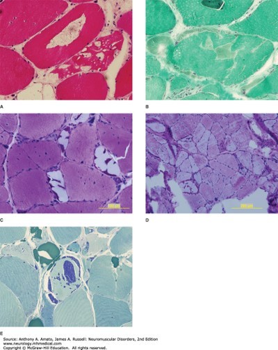 Metabolic Myopathies Diagnosis 