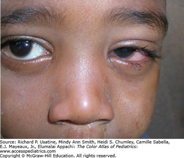 Infectious Disease Case