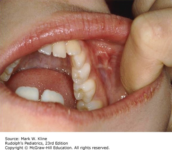 Inflammatory Bowel Disease Diagnosis 