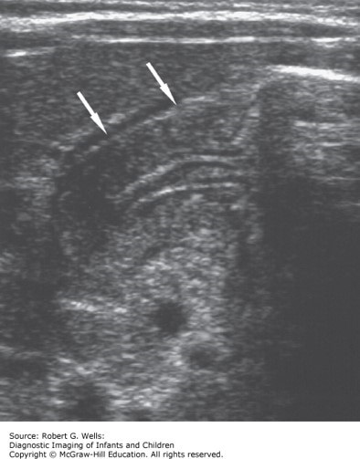 Pediatric Gastroenterology Case