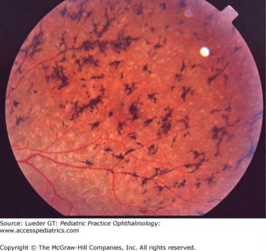 Inherited Disorders of Retinal Function Diagnosis 
