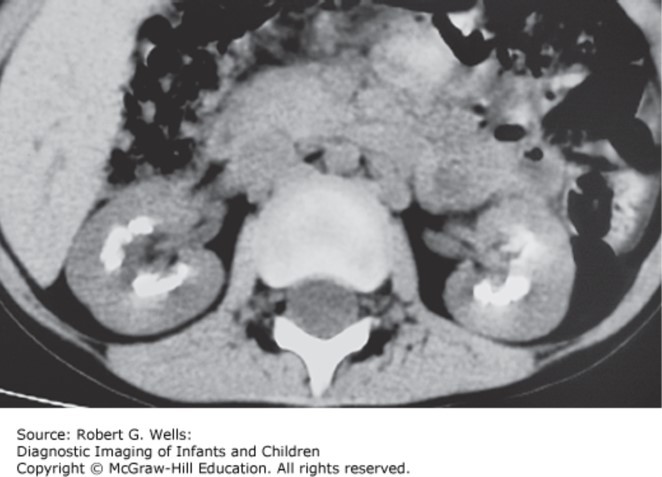 Renal and Urologic Disorders Case