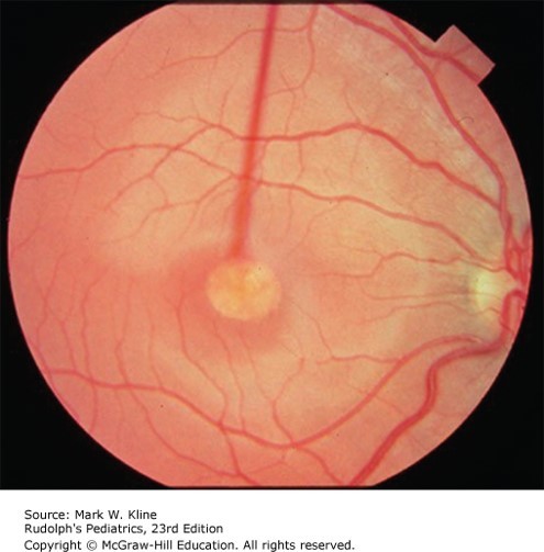 Genetic Eye Diseases Diagnosis 
