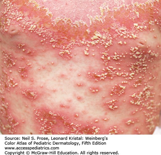 Papulosquamous Diseases Diagnosis