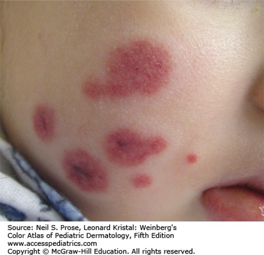 Urticarial, Purpuric, and Vascular Reactions Diagnosis 