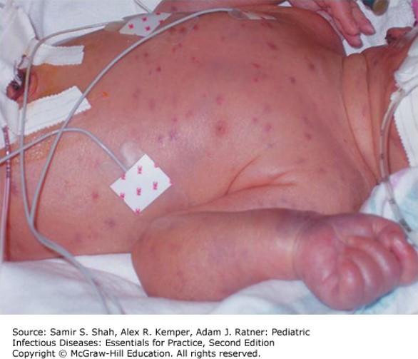 Congenital Infections Diagnosis 