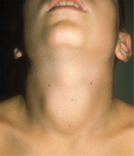 Endocrine Disorders Case 