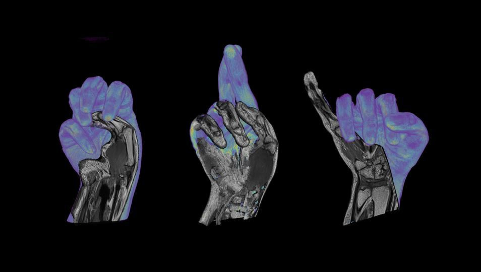 MRI detectors that fit like a glove