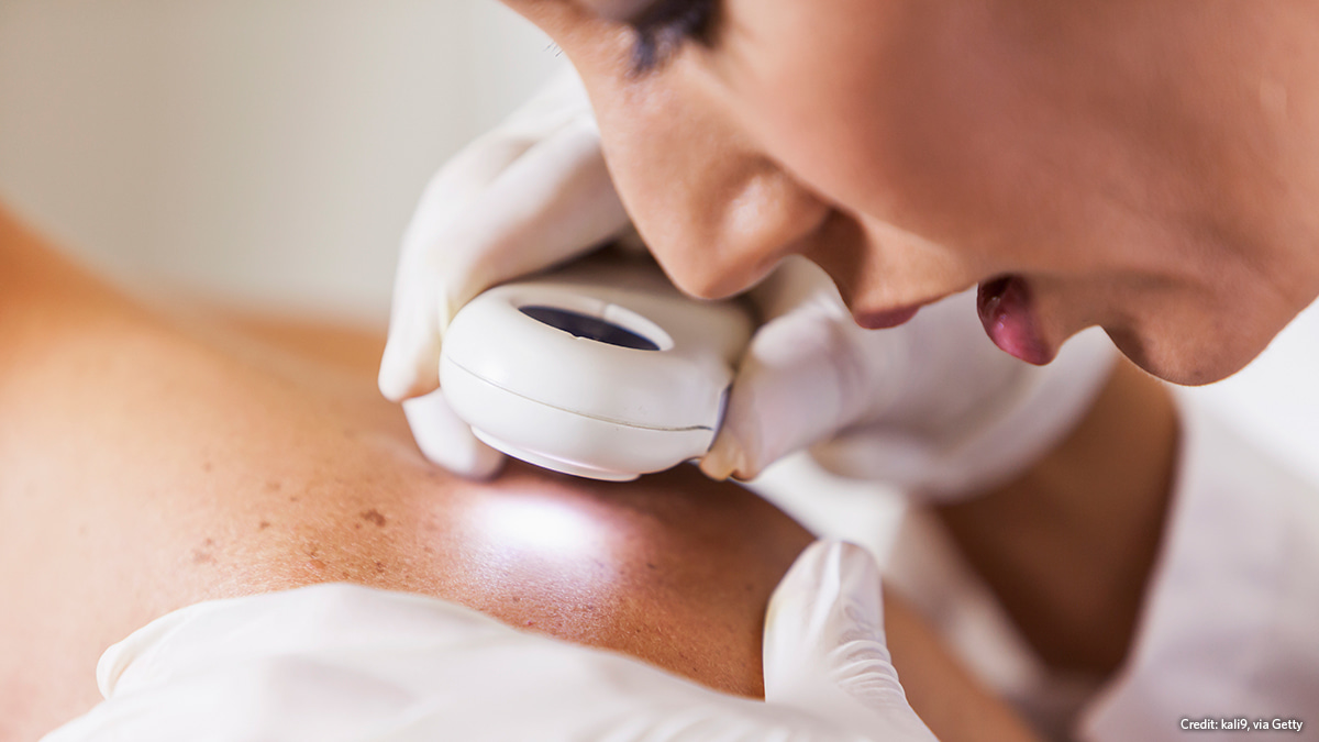 Melanoma and Skin Cancer Awareness Month: Research highlights