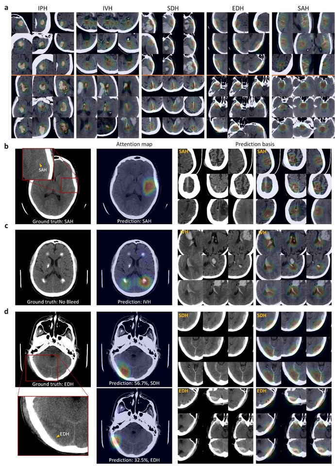 Explainable, Radiologist Mimicking, Deep-Learning for Detection of Acute Intracranial Haemorrhage from Small CT Datasets