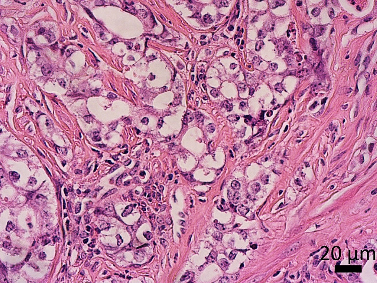 Novel poorly differentiated endometrial cancer mouse model