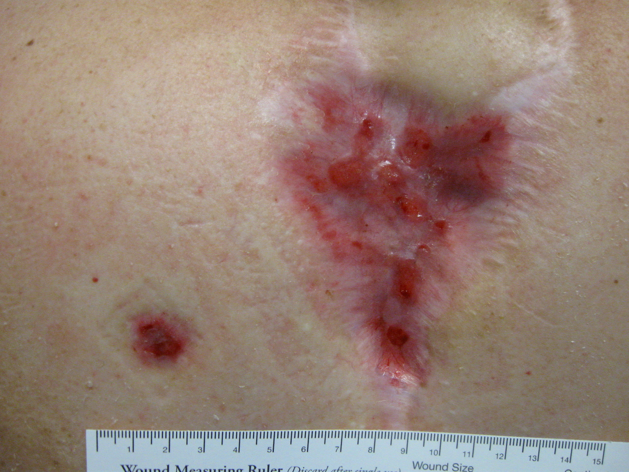 Remodeling or matauration of the wound