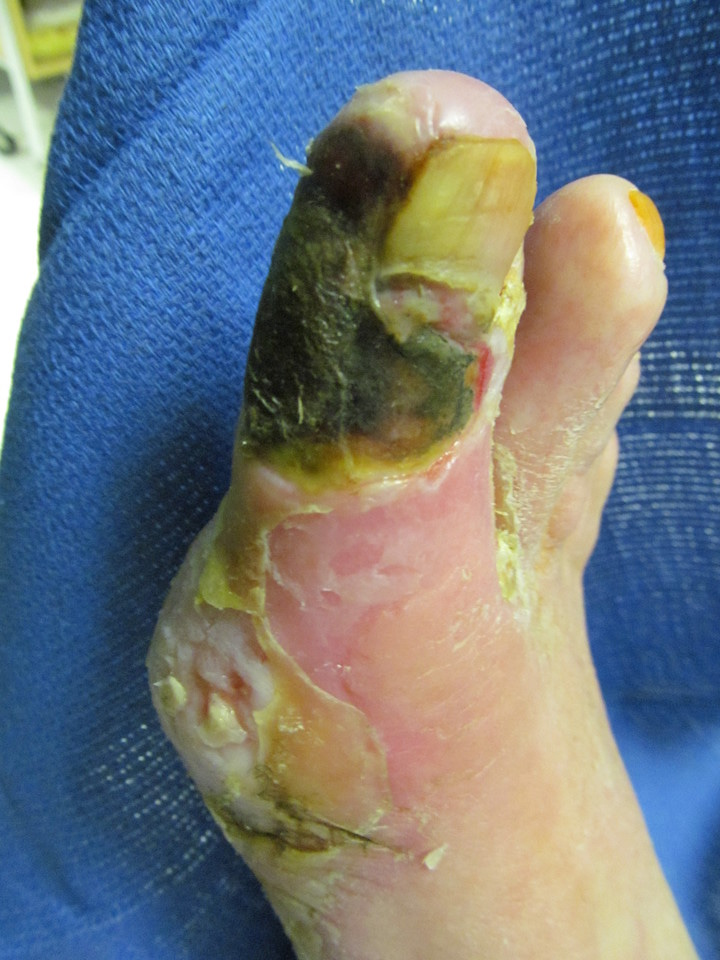 Treatment of critical limb ischemia