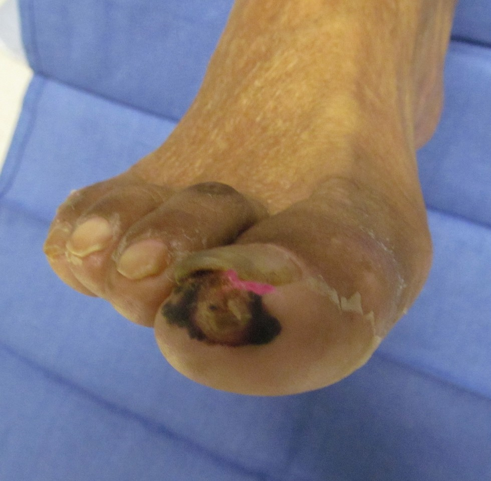 Arterial wounds in phase 1 of peripheral arterial disease