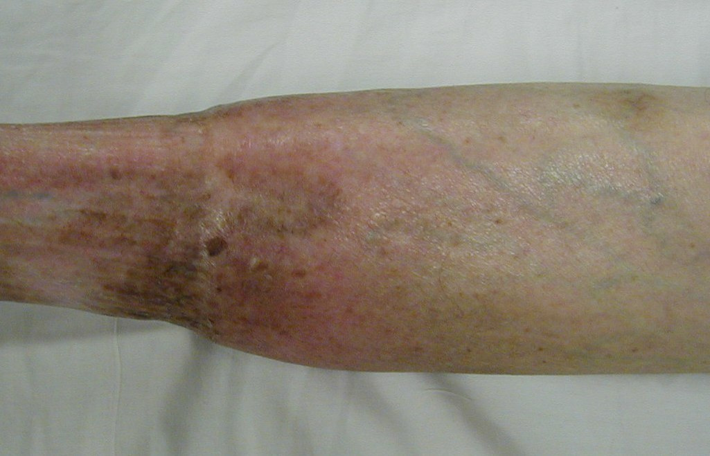 Chronic venous insufficiency, Part 1