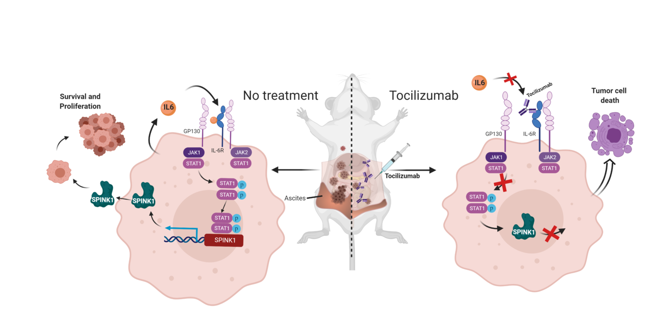 Targeting an autocrine IL-6–SPINK1 signaling axis to suppress metastatic spread in ovarian clear cell carcinoma