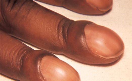Nail Disorders Diagnosis