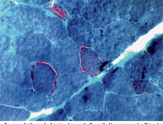 Toxic Myopathies Diagnosis